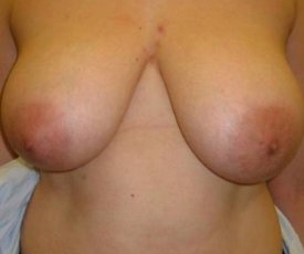 Manhattan Breast Reduction before 4